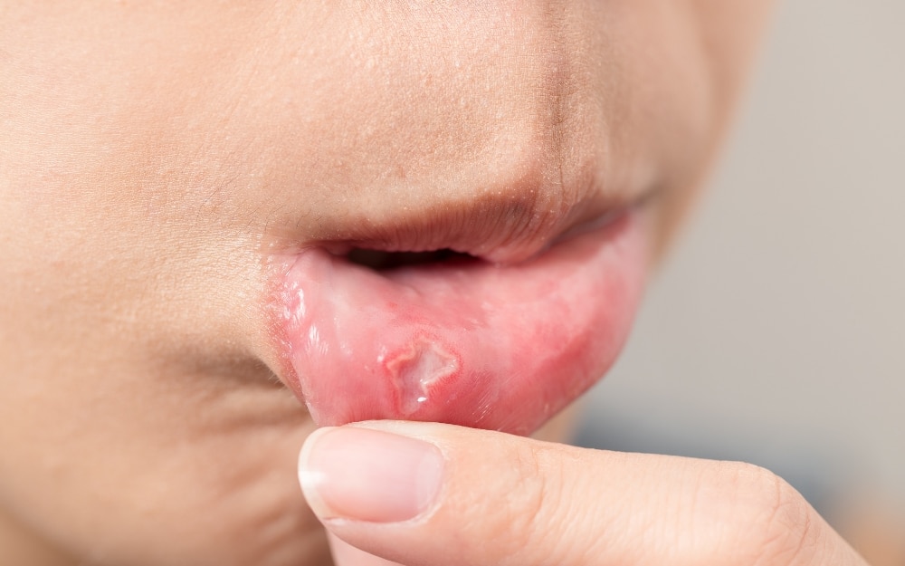 woman holding bottom lip showing mouth ulcer